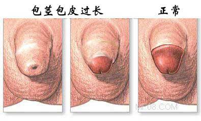什么原因引起的包茎，你知道吗