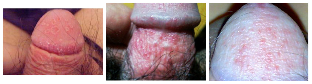 龟头炎的危害哪几种比较多见