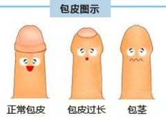 全面解析包茎症状、危害、治疗