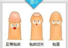包皮包茎及时治疗好处多