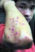 男性应如何自查慢性淋病