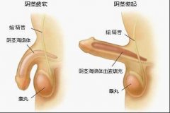 诱发男性阳痿的病因有哪些