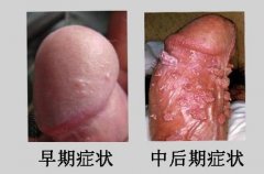 哪些检查可以确诊是尖锐湿疣
