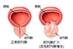 前列腺增生多发的原因