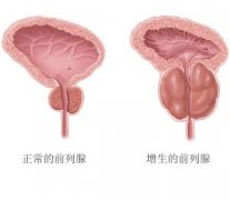前列腺增生会影响性生活质量吗