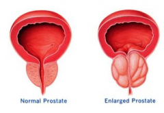 前列腺囊肿患者有哪些表现