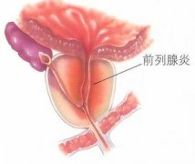科学认识：前列腺炎的病因