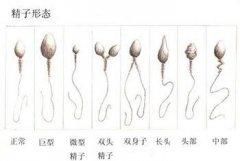 无精症典型症状