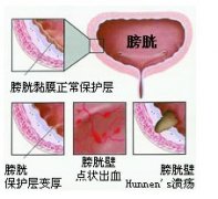 男性膀胱炎常见哪些表现