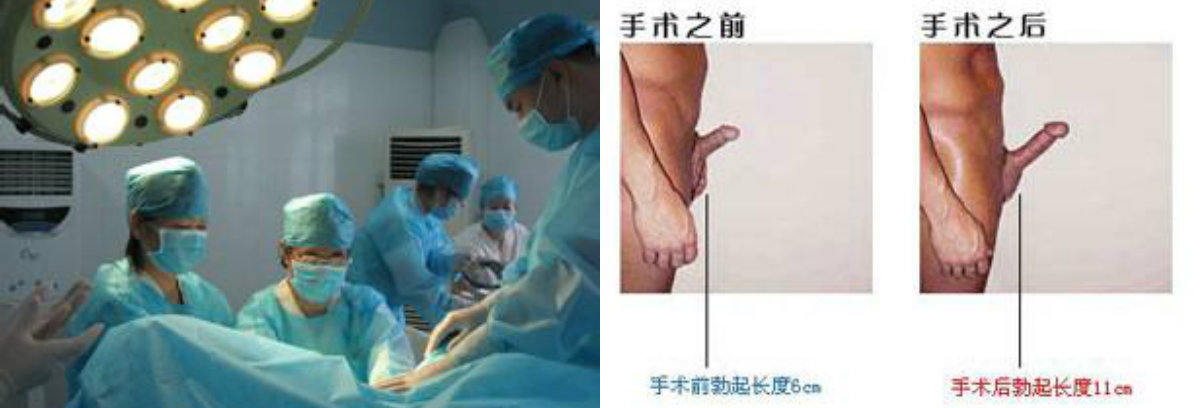 男性阴茎延长术要做哪些检查