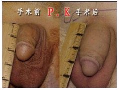阴茎短小有什么影响