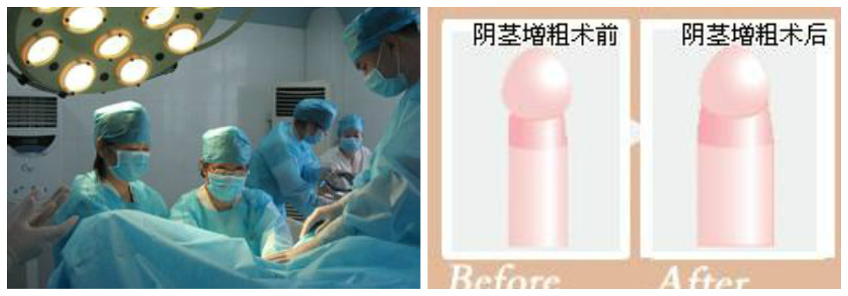 阴茎延长术多少钱呢