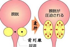 男性前列腺囊肿的症状